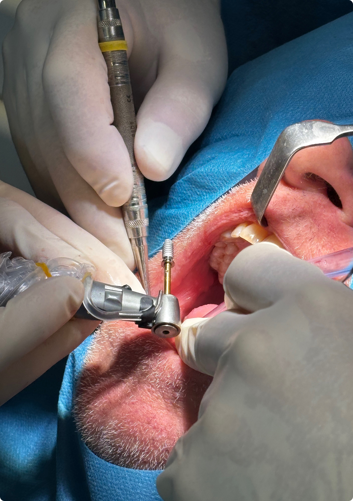 Couverture de la plaquette de formation en implantologie PractisDental